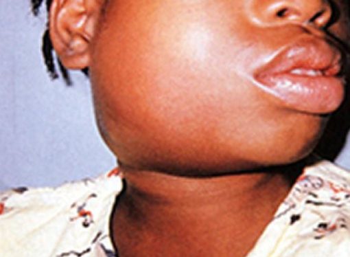 Mumps Spreads To Nearly 20 Districts.