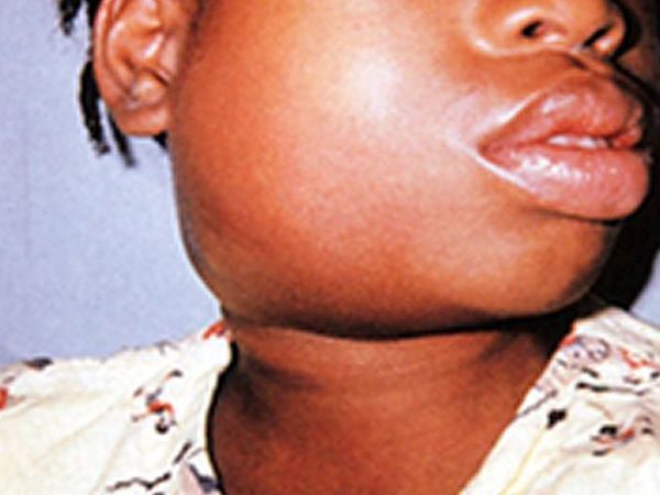 Mumps Spreads To Nearly 20 Districts.